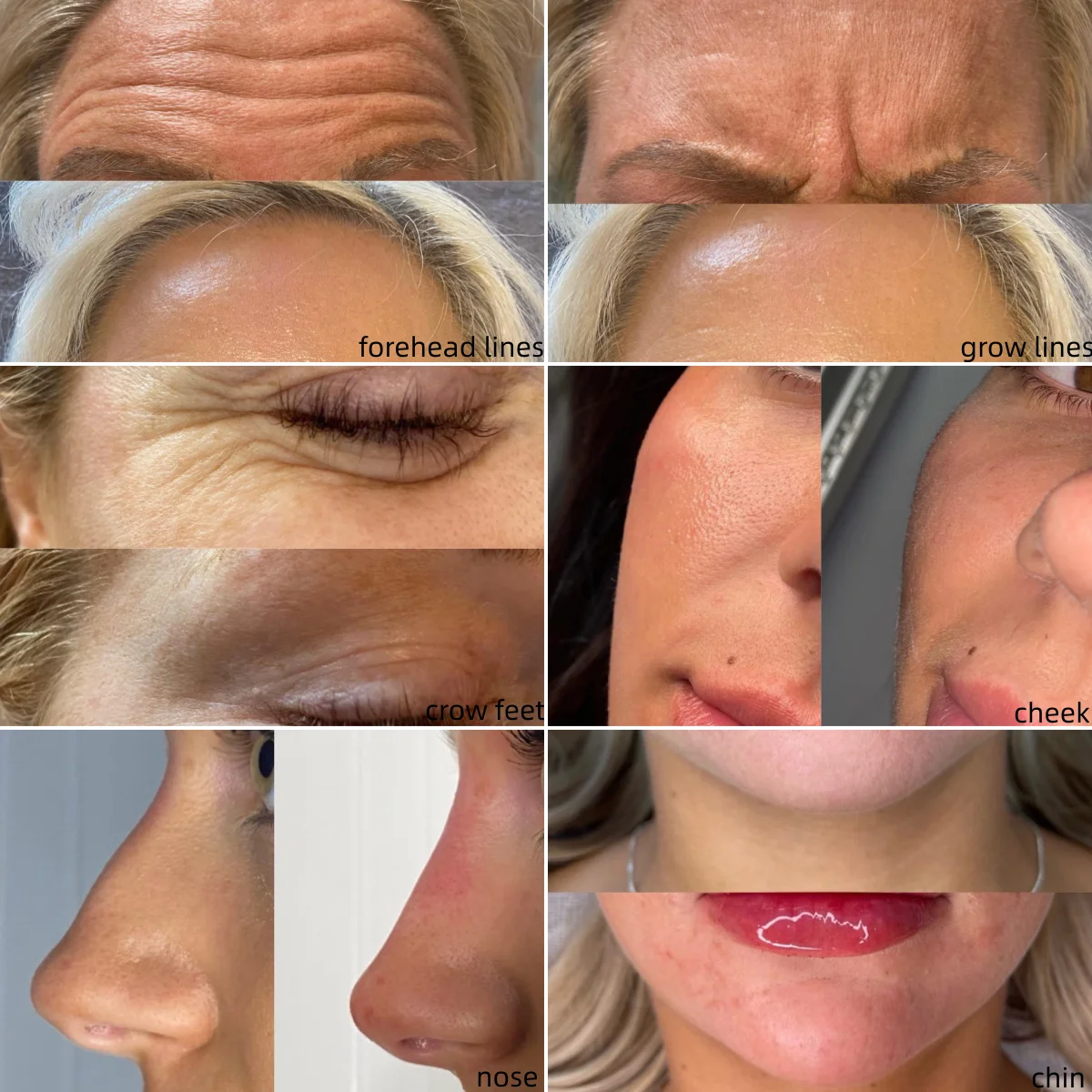 Neuramis HA Hyaluronic Acid Filler Dermal Filler Facial Filler for Forehead Nose Lips facial