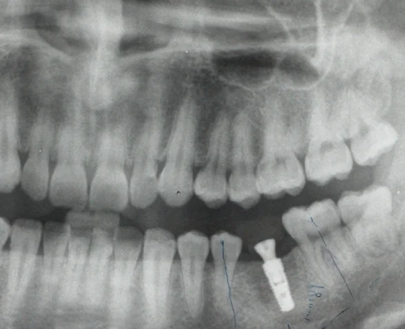 Impression Coping for Wego Dental Implant SystemTitanium Alloy Open Tray Transfers