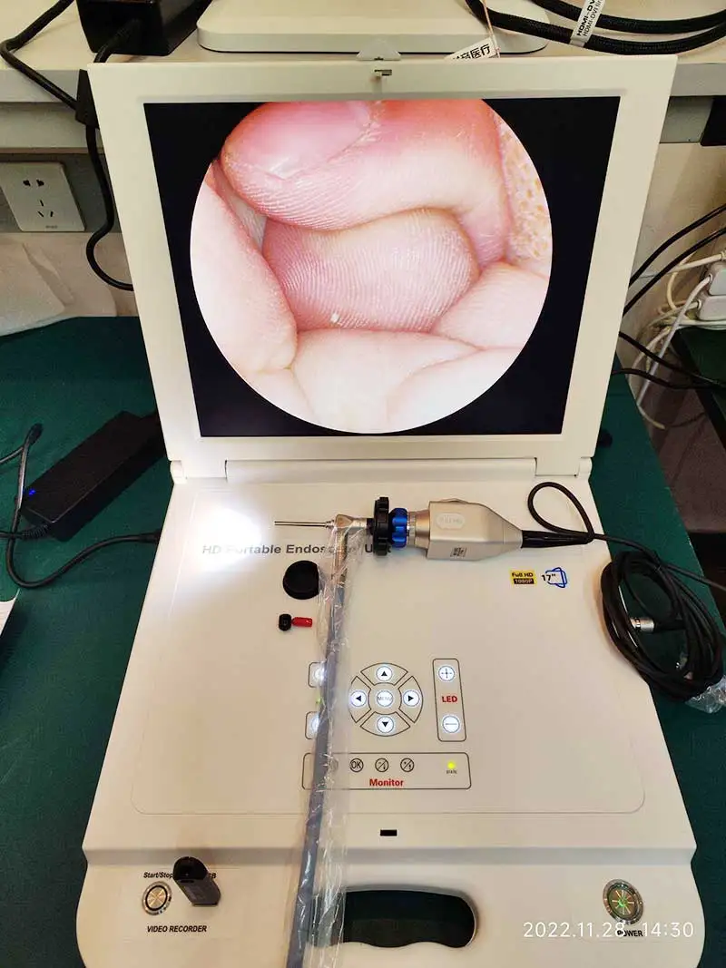 low price hd portable laparoscopic hysteroscope system from factory medical manufacturer