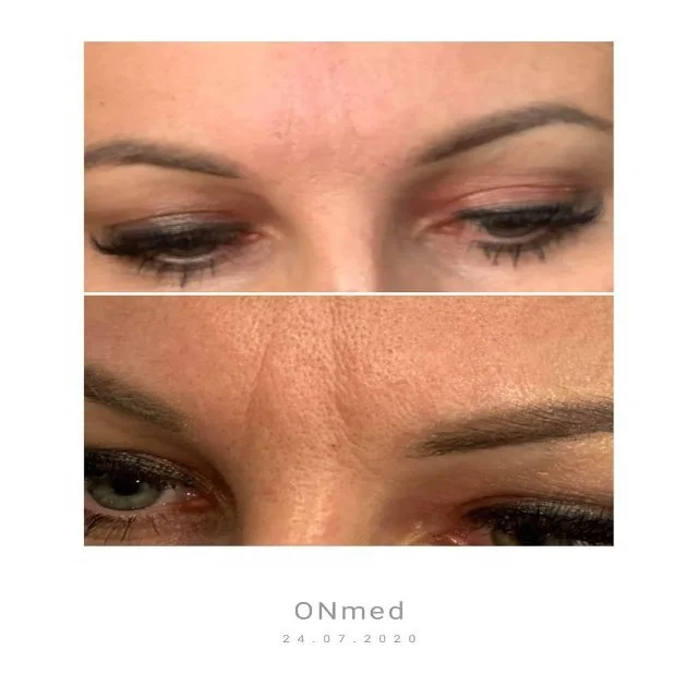 3 in 1 Complex Light Filler Effect Boosts Skin Rejuvenation and Elasticity ONmacabim ON-3B Solution