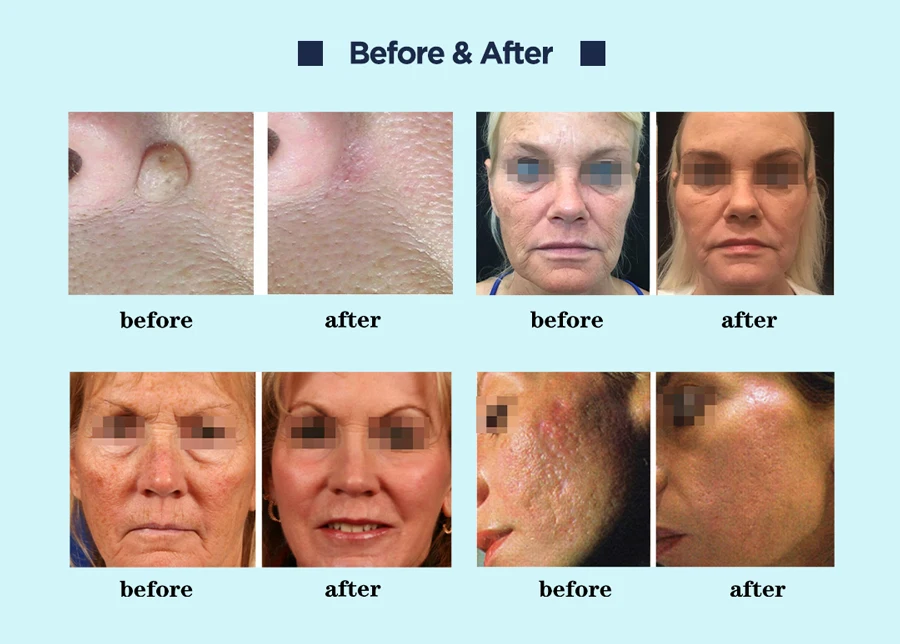 ADSS 2024 professional fraction laser co2 machine