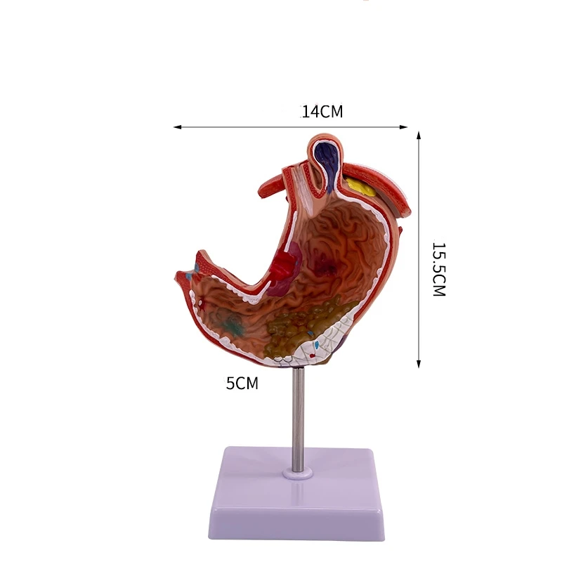 Medical Stomach Demonstration Human Stomach Anatomy Pathology Gastric Digestive System Model Gastroenterology Toy Model