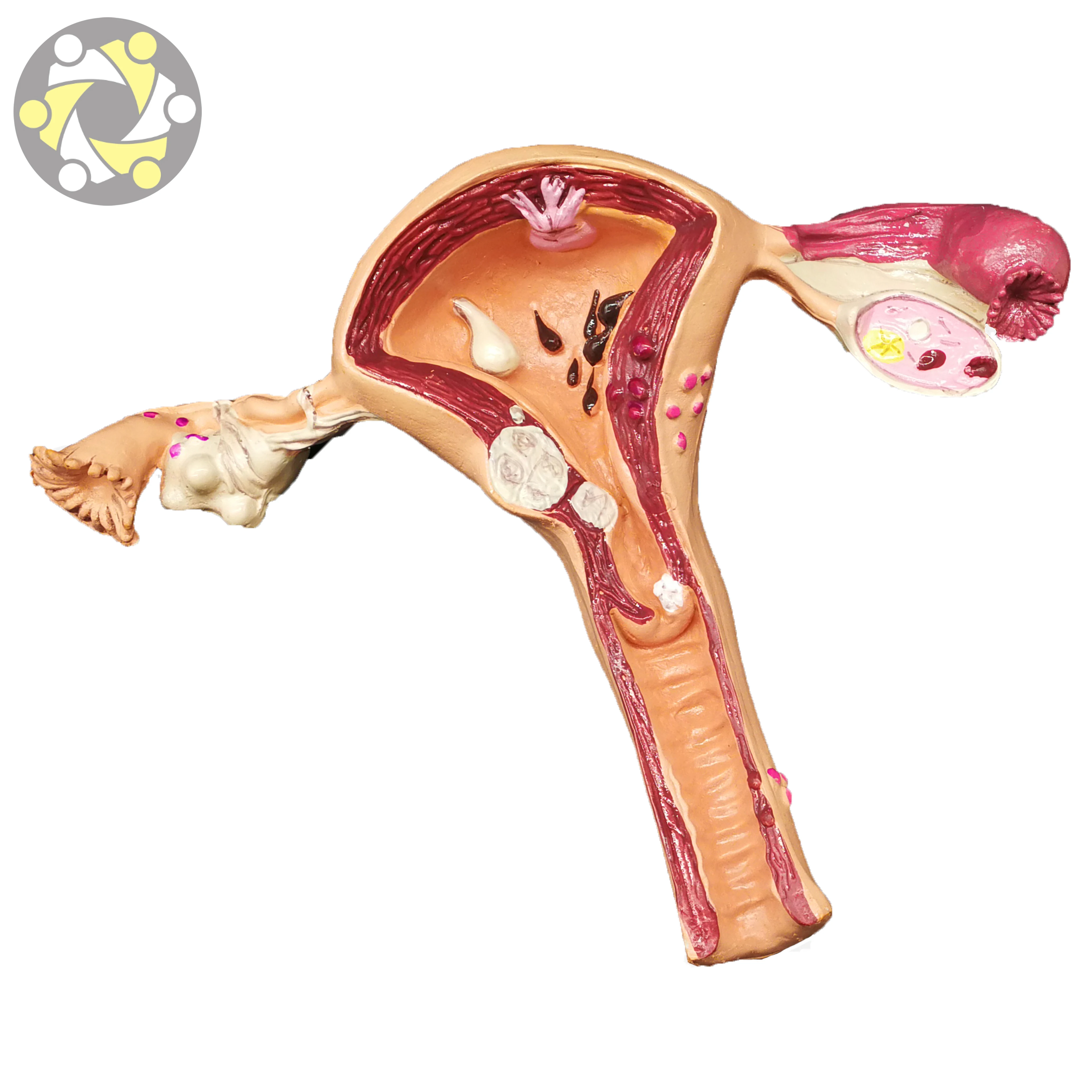 Female Uterine Fibroids Pathological Anatomical Model PVC Material for Medical Science and School Usage