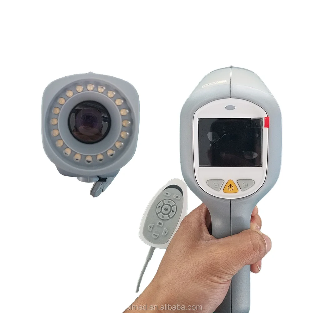 Medical CE Handheld Colposcope Portable Gynecology Colposcopy System Digital Electronic Gynecology Video Colposcope