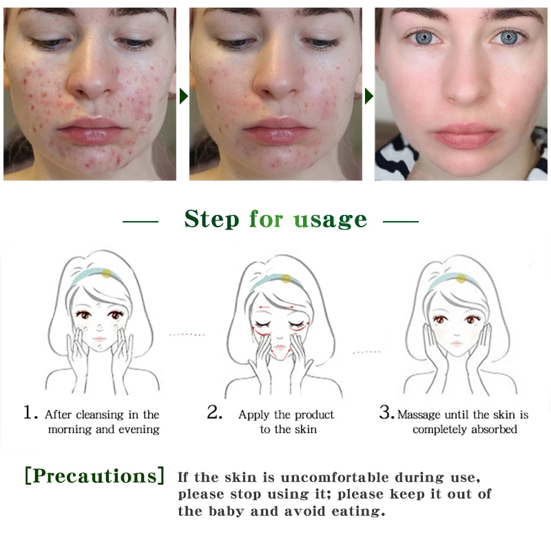 Oligopeptide acne cleaning lotion serum Vitamin A Oil Control Pore Refining Glycolic Acid Anti Acne Aha Serum