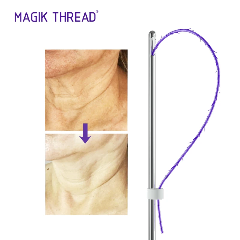 Magik Thread 3d cog pdo 19G 100mm cosmetic  pdo suture cara barb thread cog