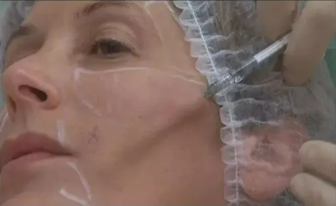  COG 3D 21 г 60 мм Pdo резьба лифтинг 3d треска Блант canula Корея