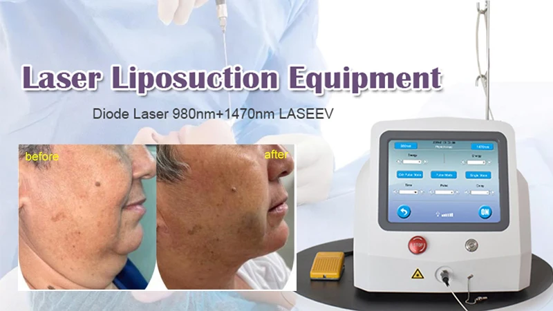 TRIANGELASER Diode laser 980 1470nm vaser lipo laser beauty equipment for sale