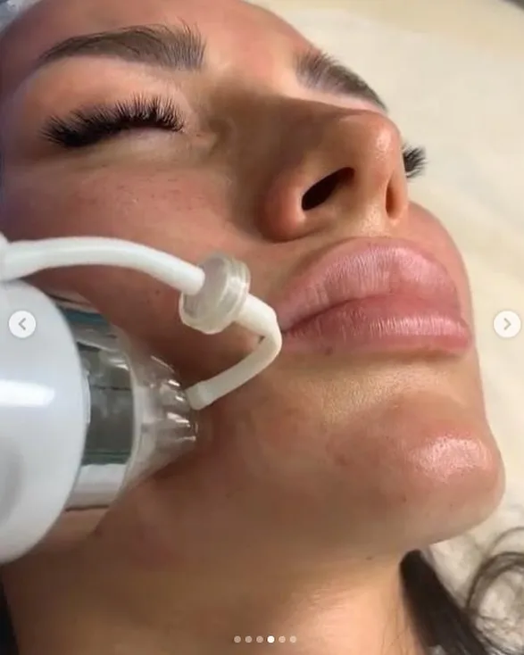 stretch mark machine Fractional Microneedle Skin Tightening Face Lifting Morpheus 8 Needles RF Microneedling Machine