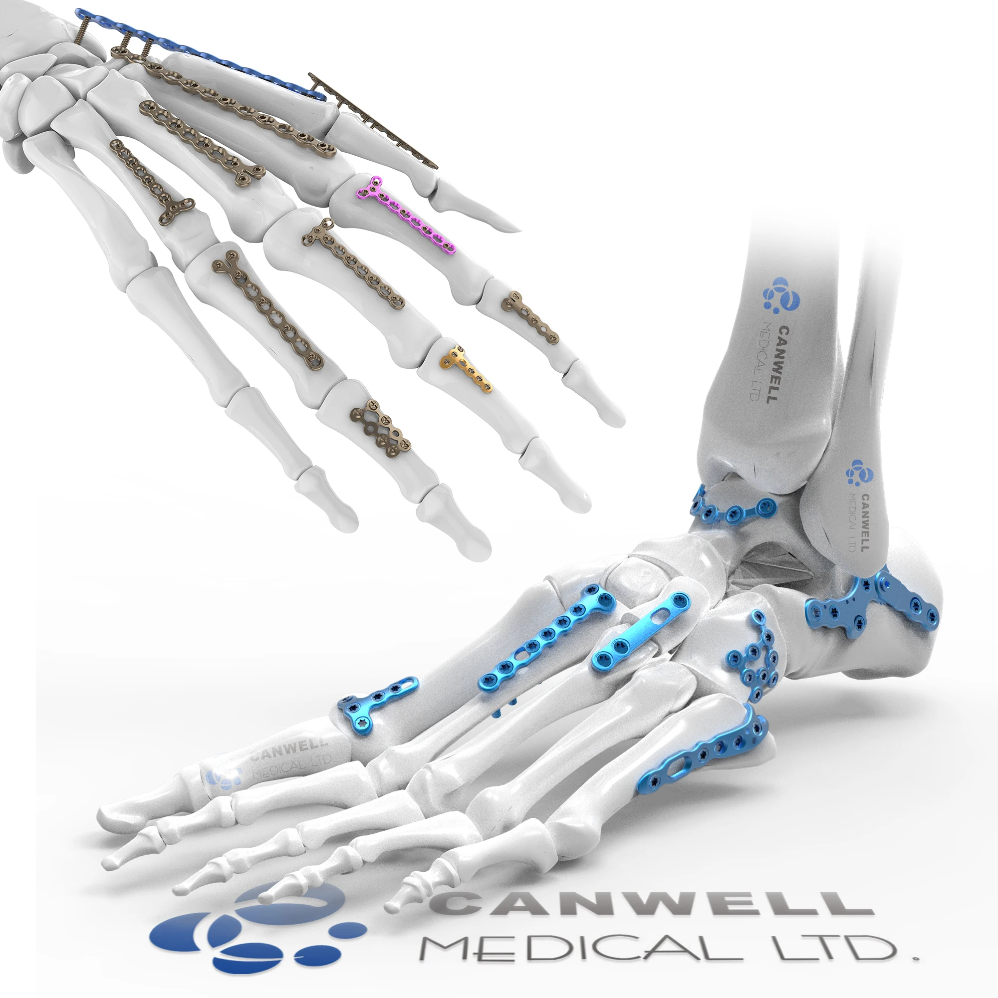 CANWELL Orthopedic Titanium Implants Mini Locking Fragment Plate Good Price Mini Finger And Foot Locking Plate