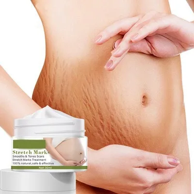Private Label Herbal Extract Body Skin Anti Strech Marks Pregnancy Mango Stretch Mark Removal Cream