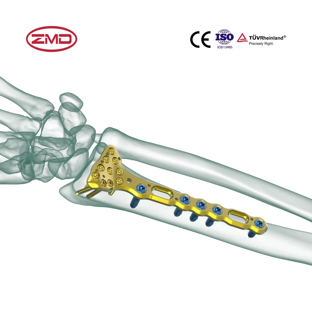 High Quality Factory Radius Distal Palm Orthopedic Implant Locking Compression Plate