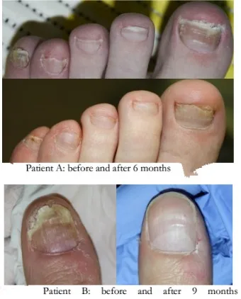 Лучший класс IV лазер онихомикоз podiatry физиотерапевтическое оборудование частная марка лечение боли при ногтях грибке