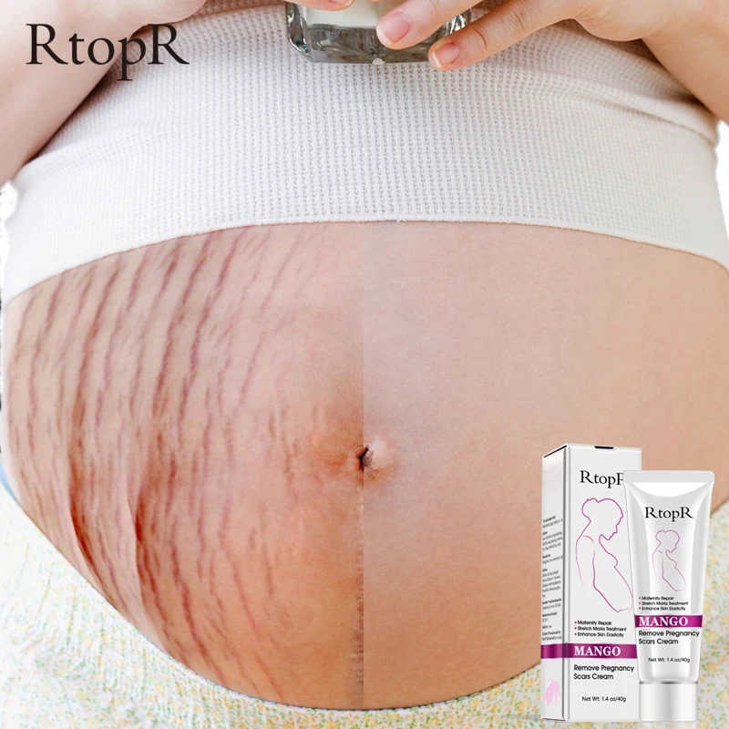 RtopR Amazon Hot Sale Best Natural Organic Mango Anti Vergeture Repair Scar Stretch Mark Removal Cream