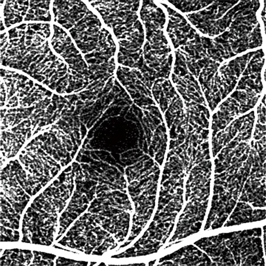 CE marked medical ophthalmology department Optical Coherence Tomography angiogrphy