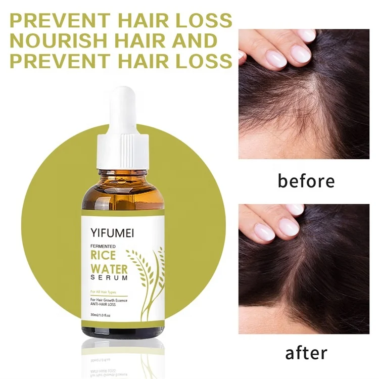 Private Label Rice Wheat Germ Bald Alopecia Hair Growth Regrowth Oil For Hair Treatment