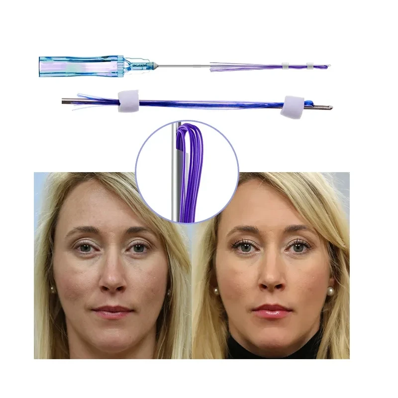 PDO hilos tensores face lift 21G38 21G 60 multi threads pcl multi threads