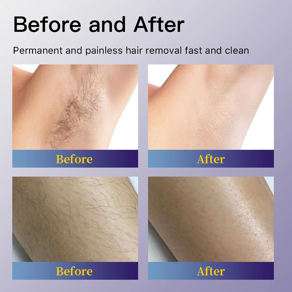 HUAMEI Fiber laser 755 nm 1064nm pro plus alexandrite laser 2024 NEW LASER fast hair removal machine with MDSAP