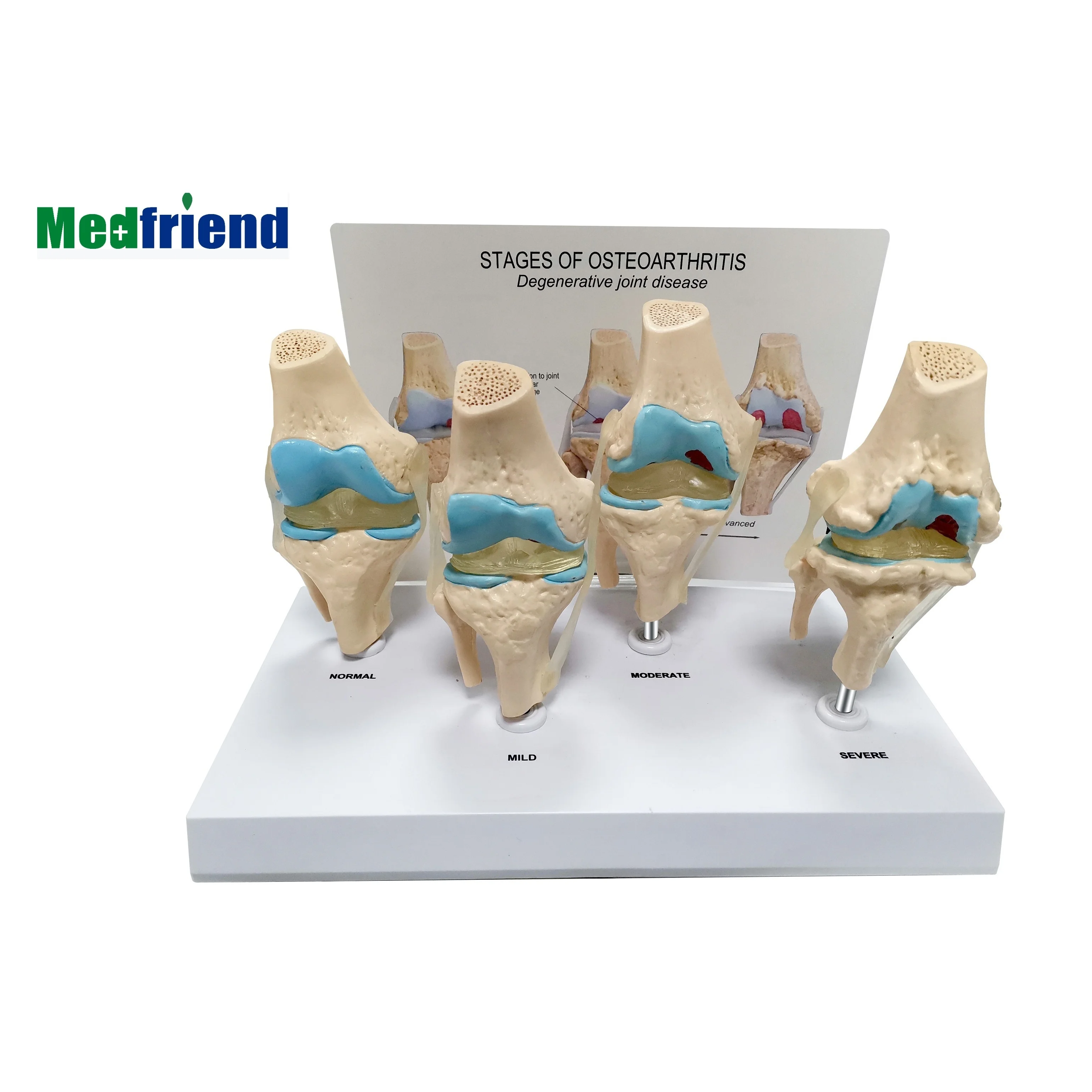 
Factory Price 4-stage Osteoarthritis Knee Model 