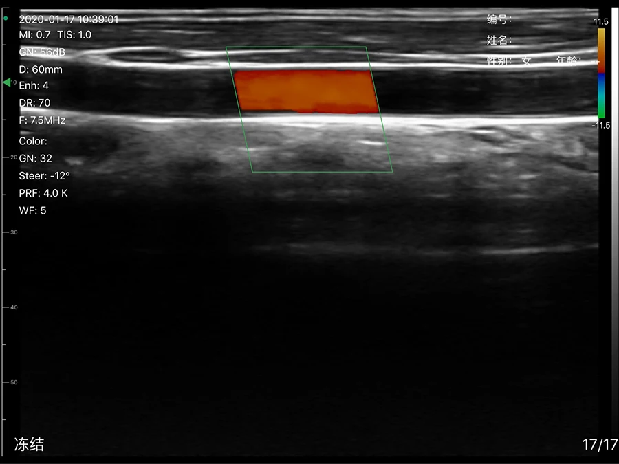 Super Width Linear Probe Type Wireless Mini Ultrasound Scanner