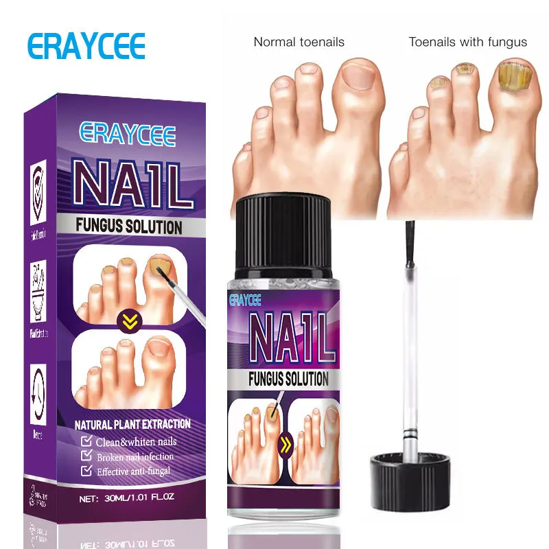 Feet Care Nail Foot Whitening Toe Nail Fungus Removal serum Gel Anti Infection Paronychia Onychomycosis Fungal Nail Treatment