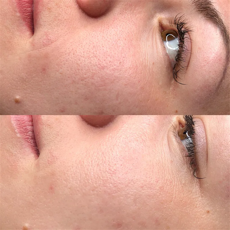 BB Meso White Serum Whitening Brightening Skin Glowing With Meso pen Meso Serum