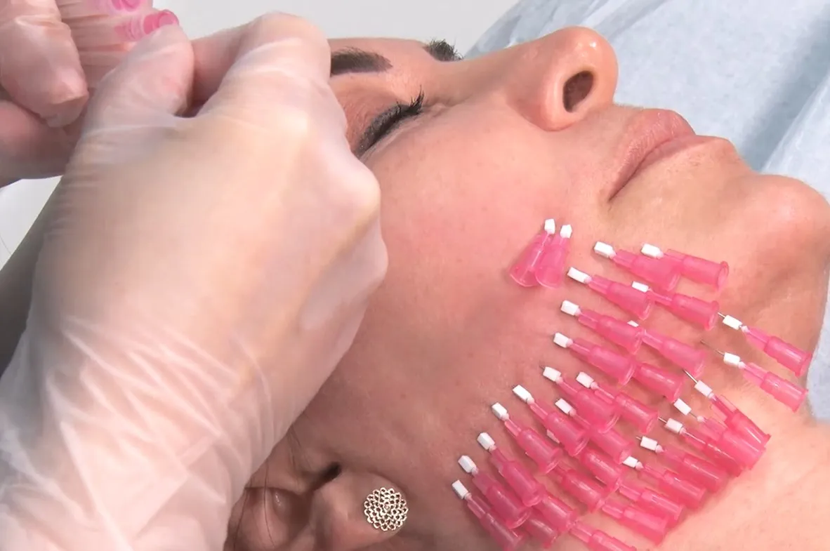 baby face pcl polylactic acid 30G  38mm mono threads south korea facial threads