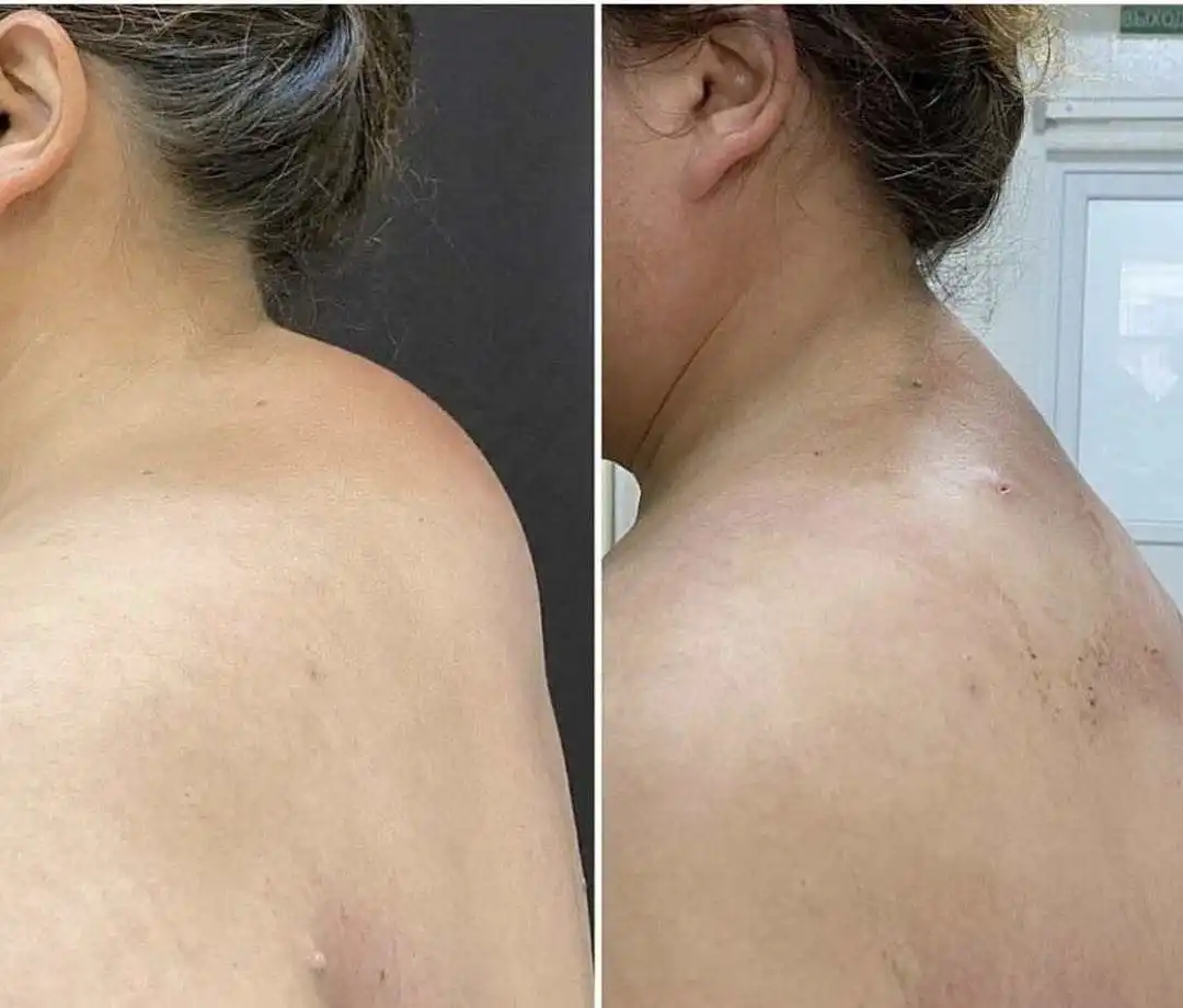 Dual wavelength diode laser 980+1470nm liposuction fat dissolution clinic use