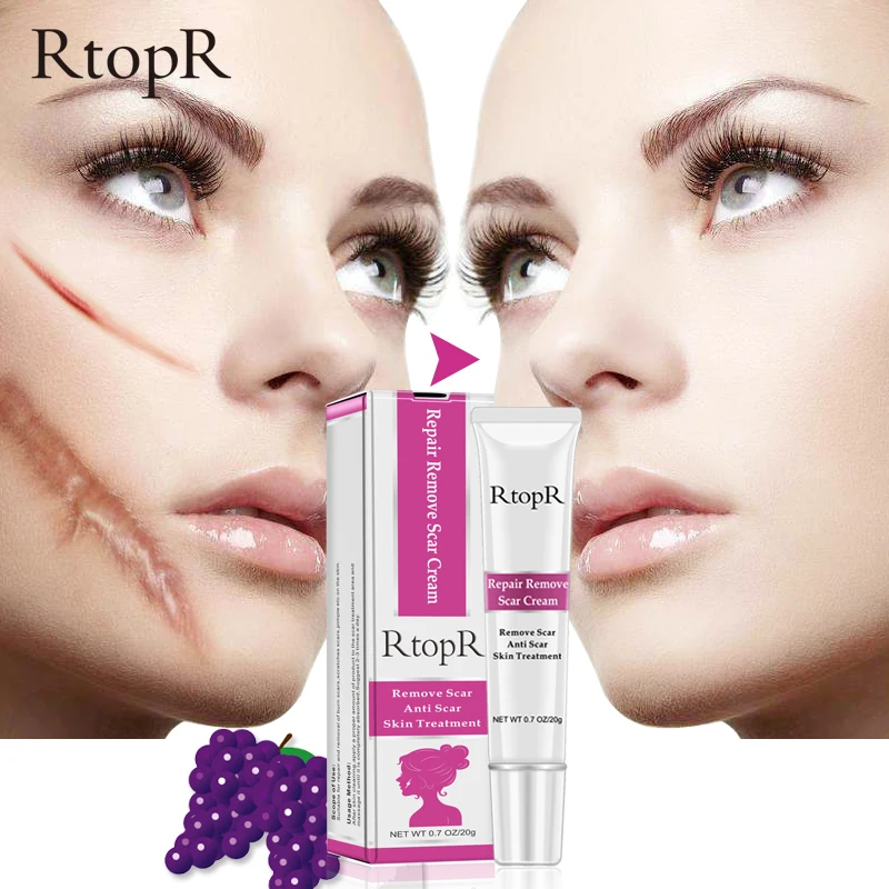 Good effect  removal scar anti scar  Acne Scar Removal Cream skin care treatment