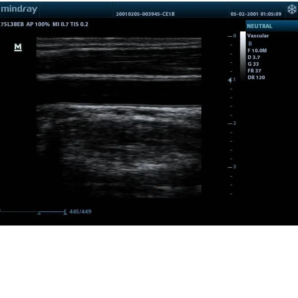  Hospital Mindray ecografo ультразвуковой dp 10 портативный Оригинальный выпуклый virginal линейный B/W сканер с выпуклым
