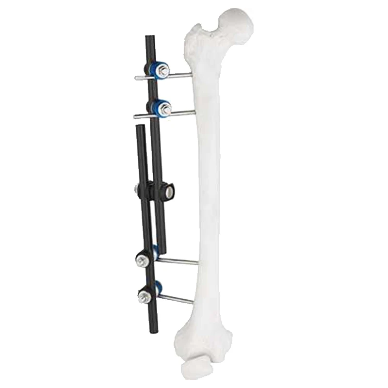 Отличное качество из нержавеющей стали ортопедический внешний фиксатор бедренной кости и внешней фиксации большеберцовой