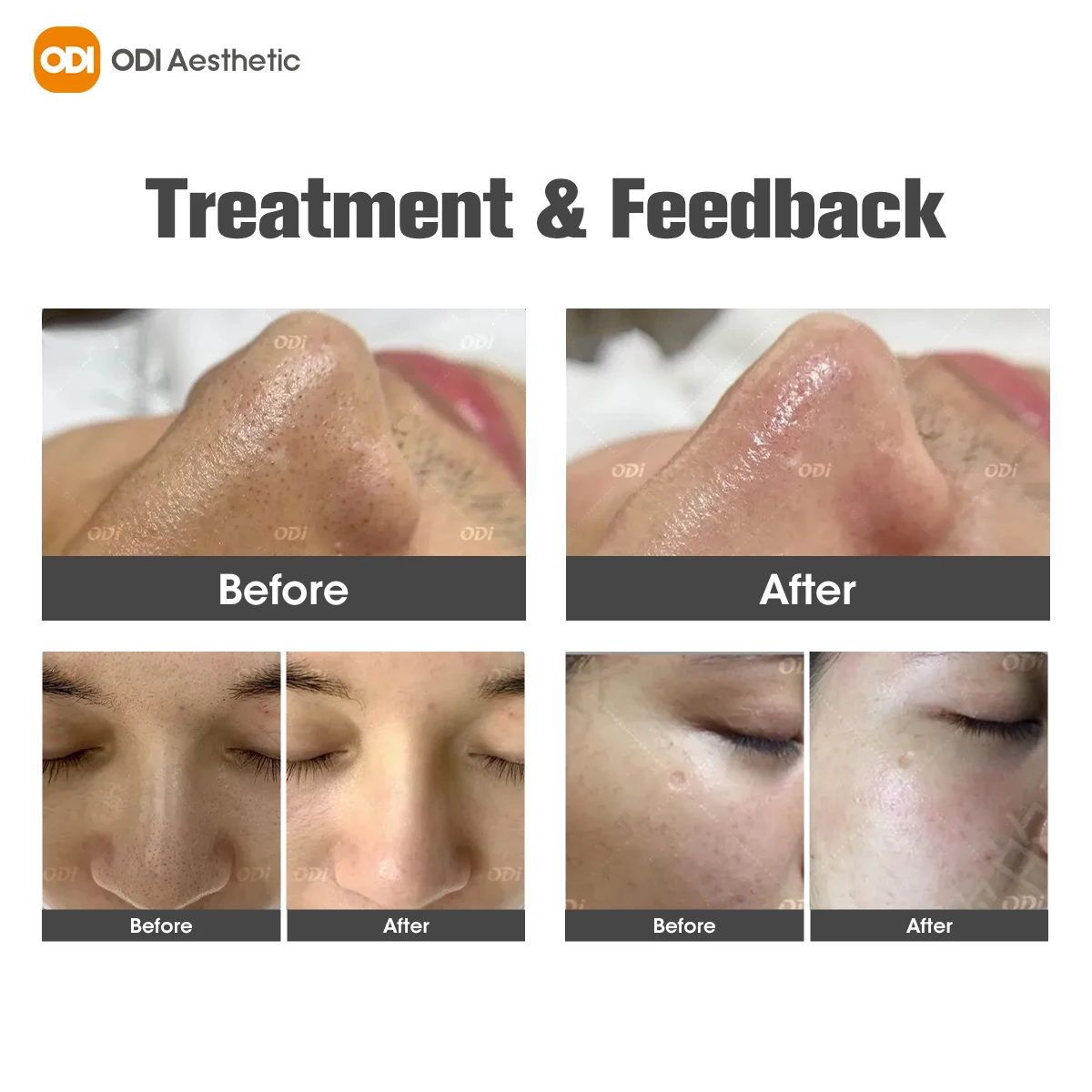 Hydrodermoabrasion Hydra Water Facial Cleaner Aqua Peel Machine Hydrafusion Facial Machine