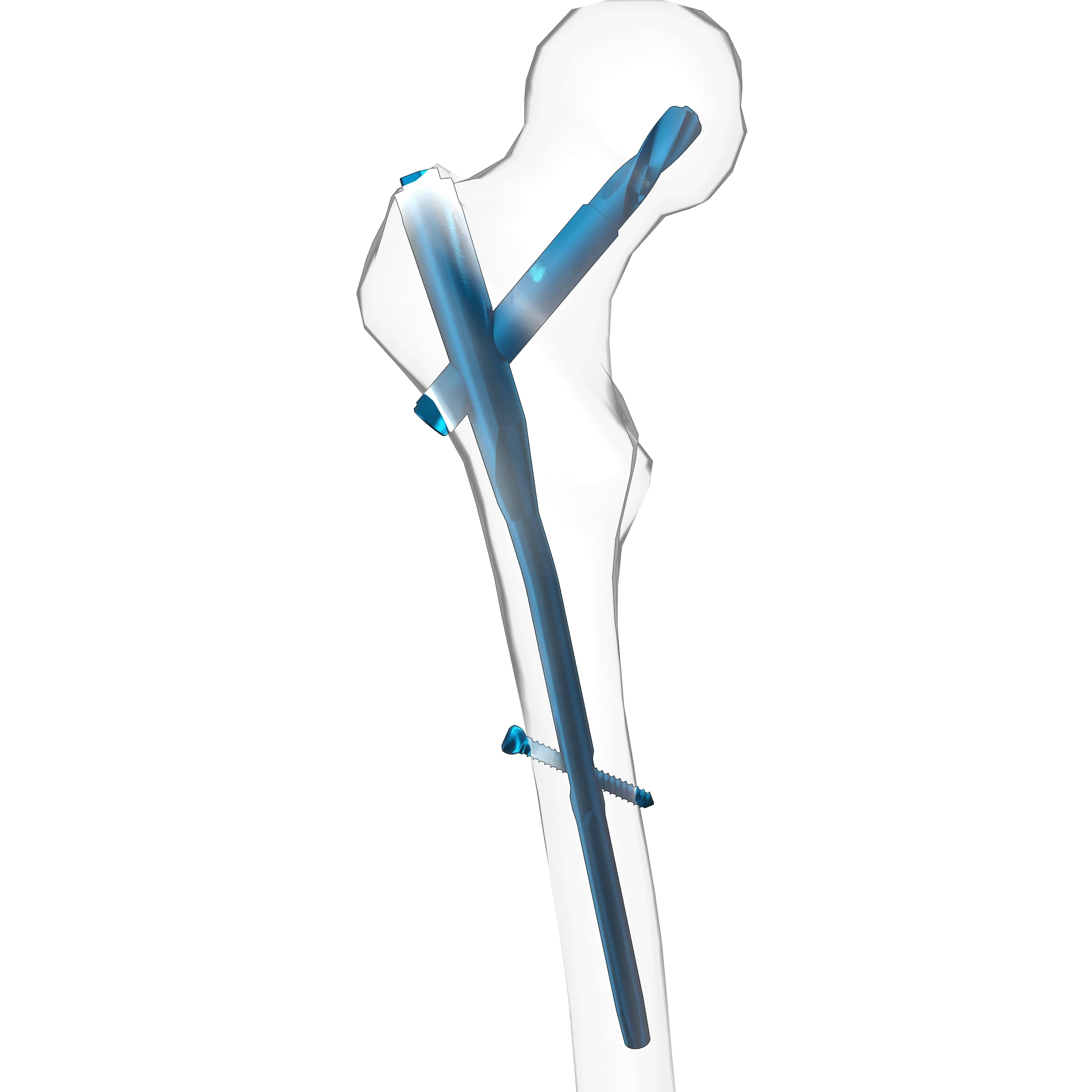 CE posterior Orthopedic PFNA Fermoral intramedullary Nail  from Beijing FULE