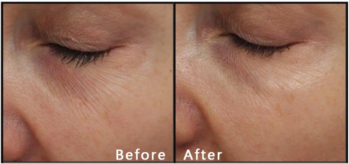 0.6mm 34g Agujas Nanosoft New 3pins Meso Nano Needles 0.6mm Agujas Nano Soft Microneedles Microagujas Nanosoft