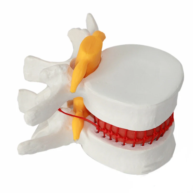 Assisted teaching Demonstration model of lumbar disc herniation Model intervertebral disc model