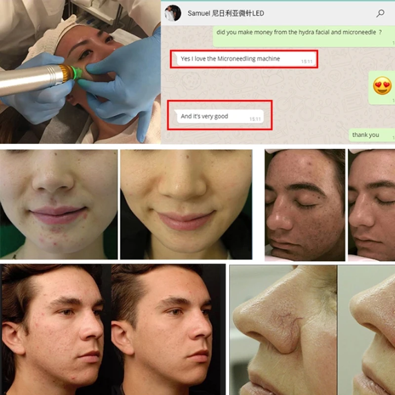  acne removal skin care 5Mhz Micro needle MFR SFR Microneedle Fractional Machine intracel rf micro
