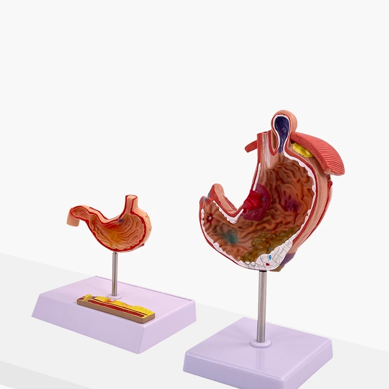 Medical Stomach Demonstration Human Stomach Anatomy Pathology Gastric Digestive System Model Gastroenterology Toy Model