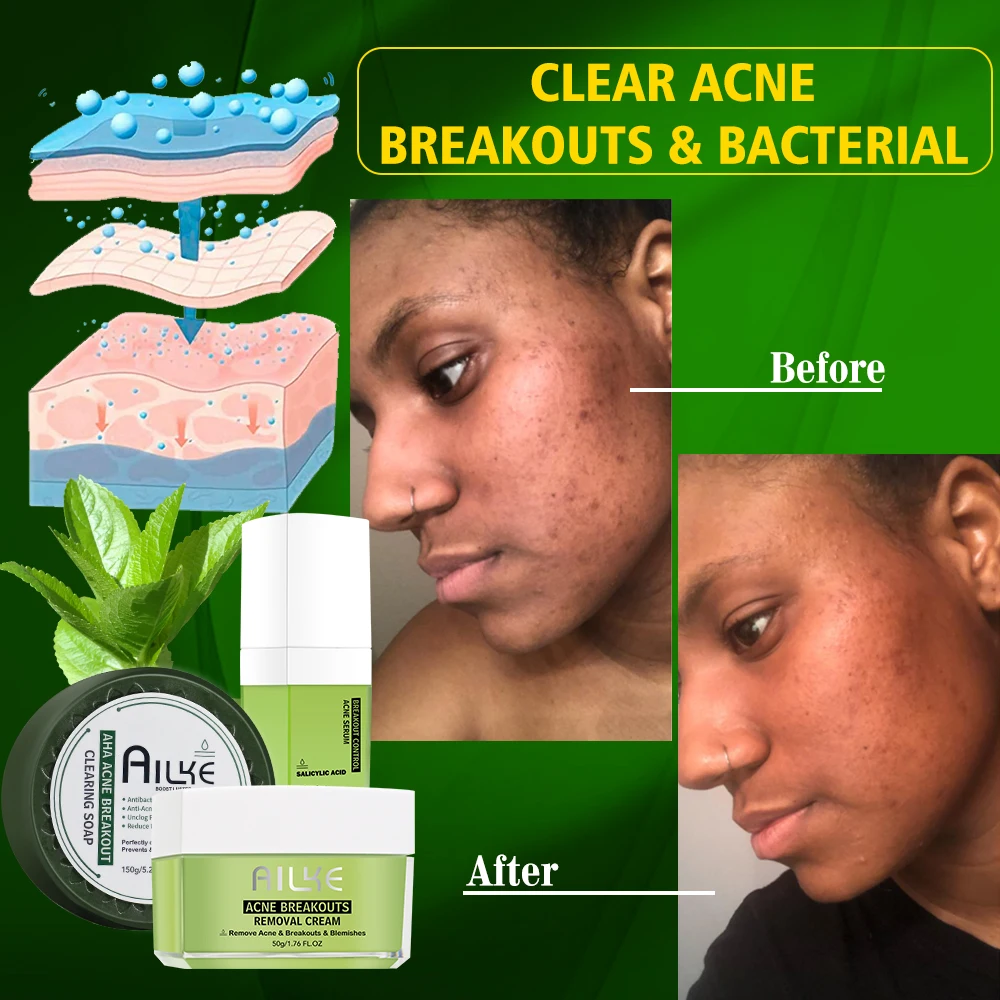 Beauty Skincare 3 Pieces Products Organic Black Skin Oily Face Beauty LKIAE Anti Acne Skin Care Set For Black Women