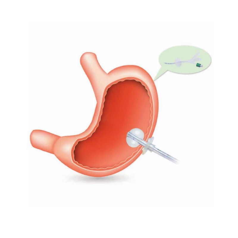 
24 fr 22fr 12fr medical silicone mic-key halyard percutaneous endoscopic gastrostomy feeding tube peg tube 