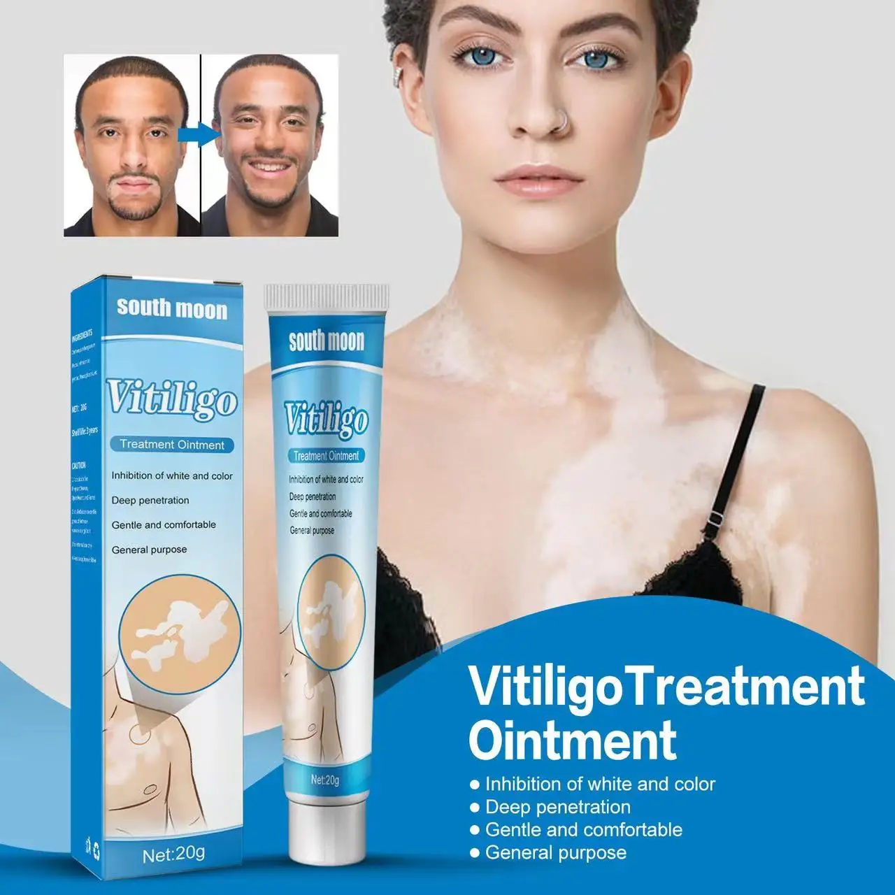 White Spot VitiligoTreament White Spot Skin Repair Psoriasis Localized Vitiligo Ointment Leukoplakia Treatment