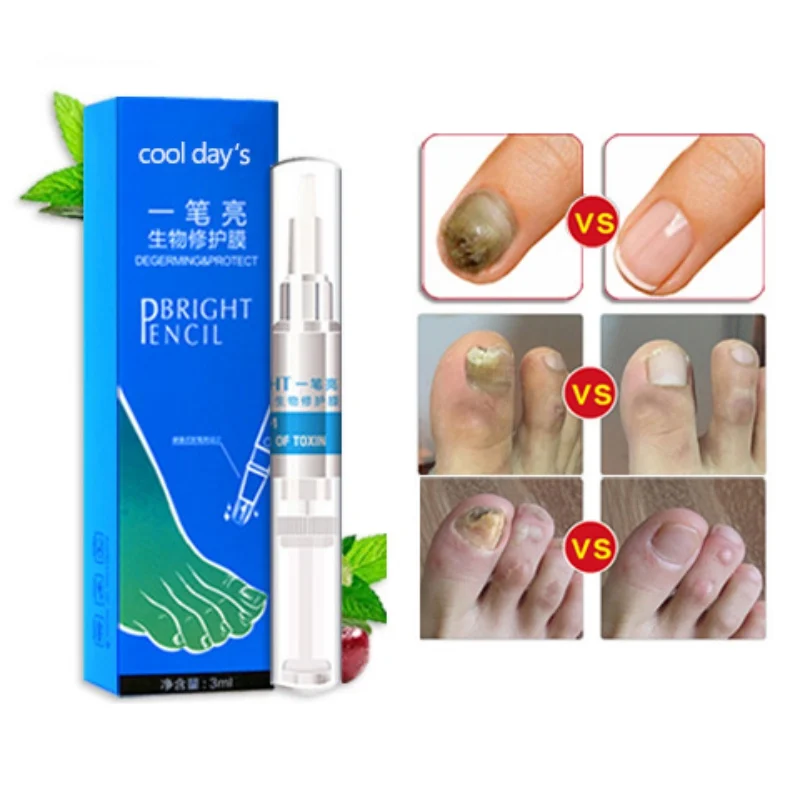Nail Treatment From Fungus on Feet and Hand Disinfection Nail Fungal Treatment Oil Pen Manicure Treatment Tools