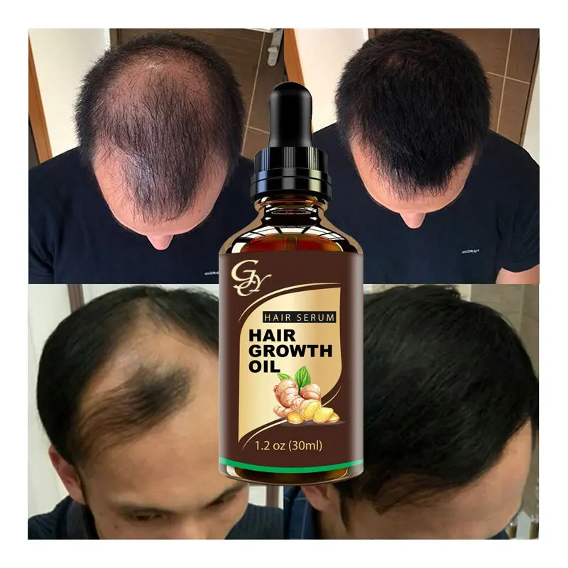 Hair Growth Oil Anti-hair Loss Serum Private Label 30ml Scalp Growth Hair Treatment For Woman Man