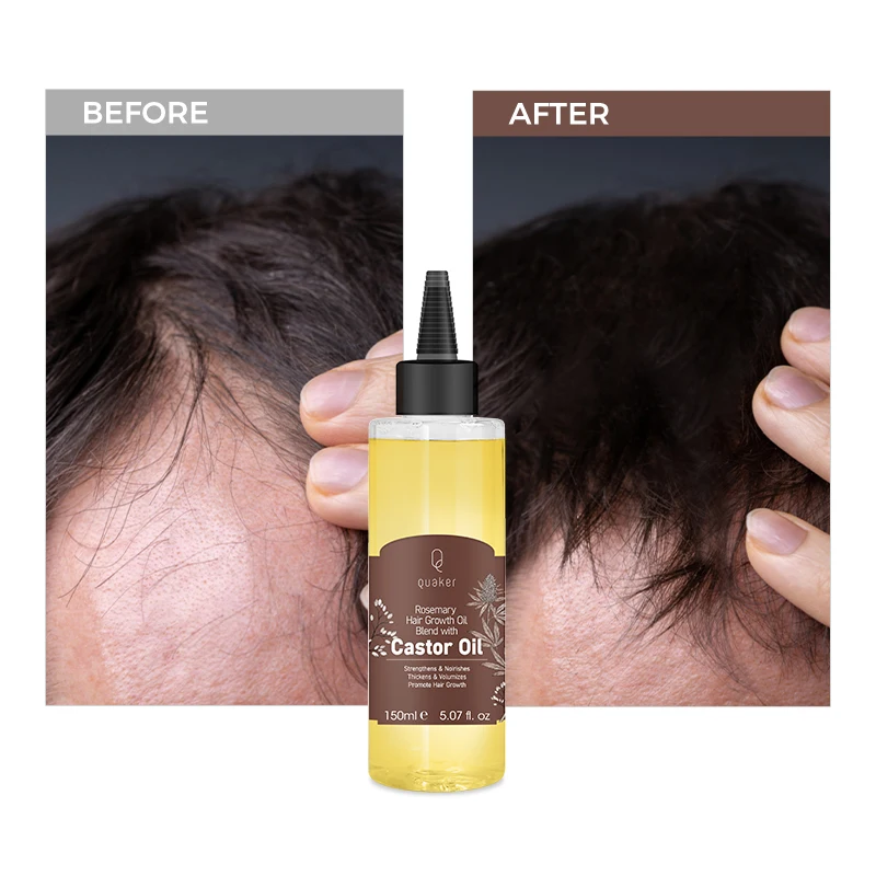 Qquaker Aceite De Romero Para El Crecimiento Del Cabello Castor Oil Hair Growth Oil For Men Organic Hair Oil