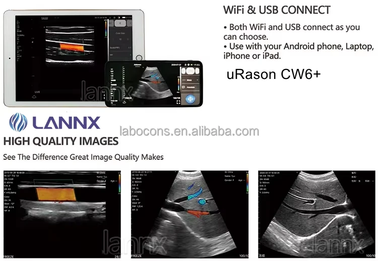 LANNX uRason CW6+ Customized Medical Wireless Convex Linear array probe ultrasound portable wifi ultrasound probe scanner system
