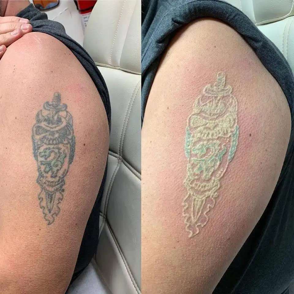 2023 q switched nd yag laser tattoo removal machine q switch laser with South Korea imported light guide arm