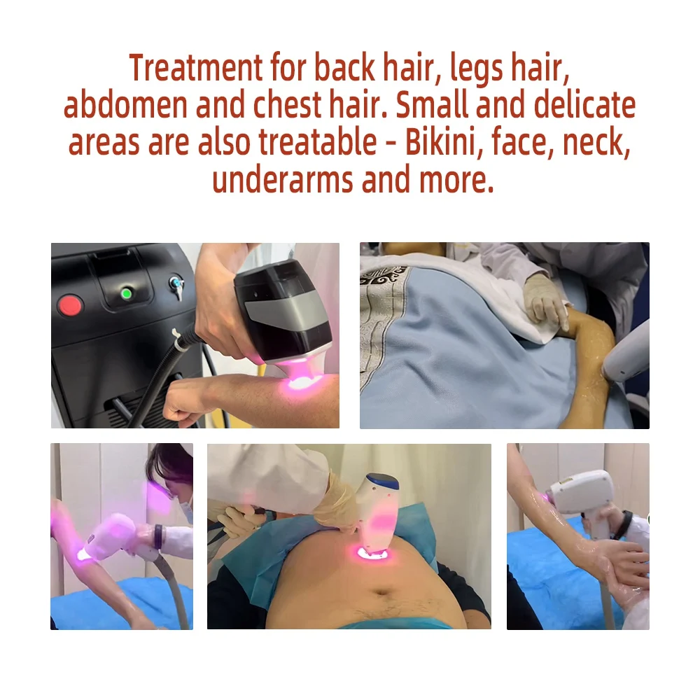 Диодный лазер 755 нм 808 1064 Диод с тройной длиной волны 50 млн. диодов удаление волос помощью лазерного аппарата цена