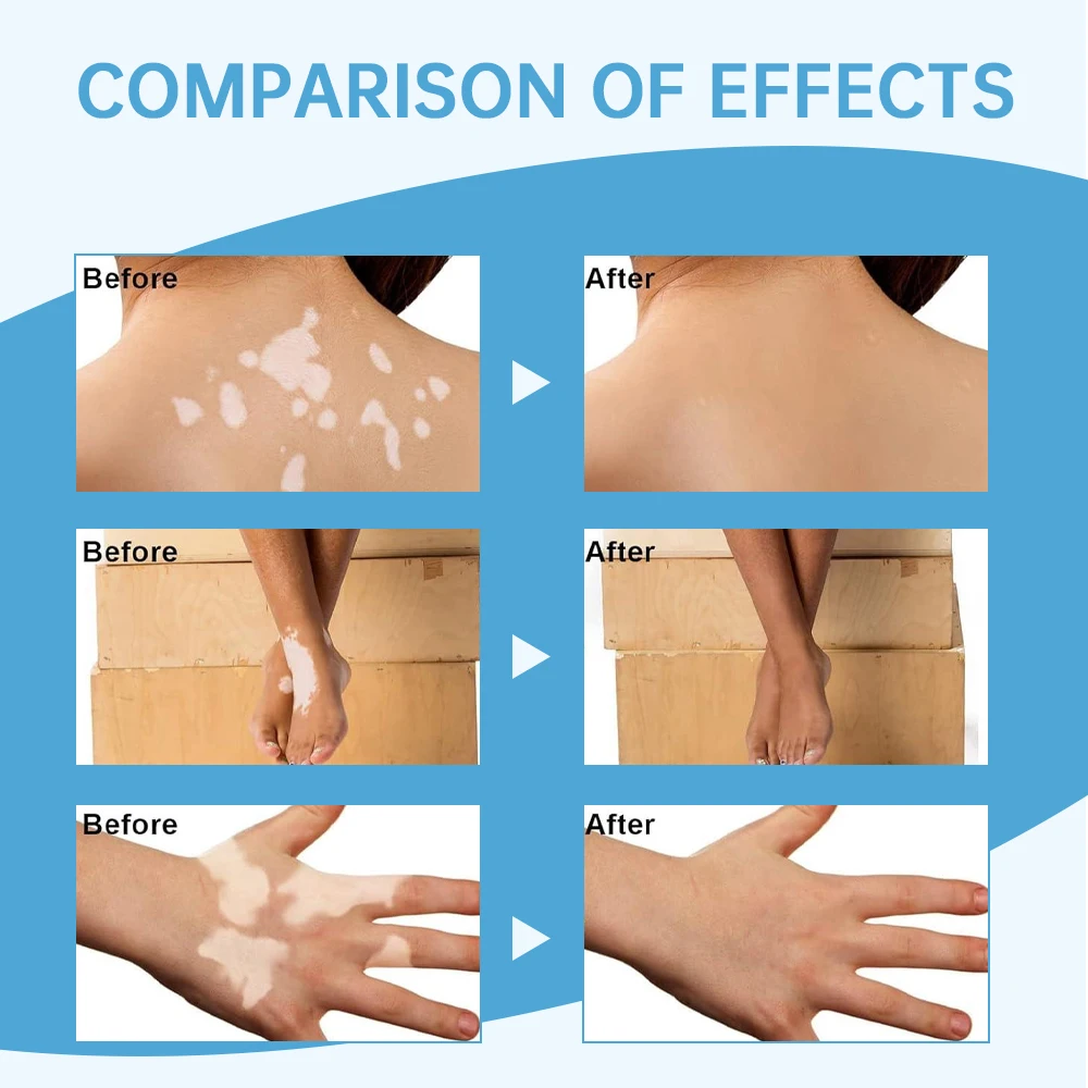 Sumifun Wholesale 30ml Vitiligo Treatment Remover Spray White Spot Skin Care Spray
