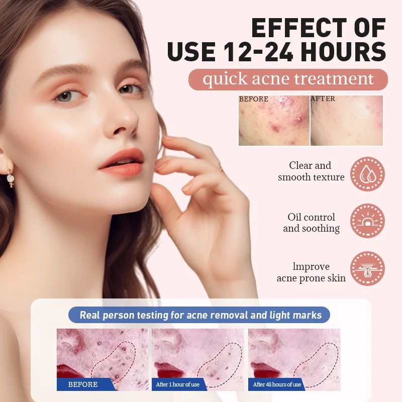 Acne Treatment Powder Water Serum One day quick action new formula