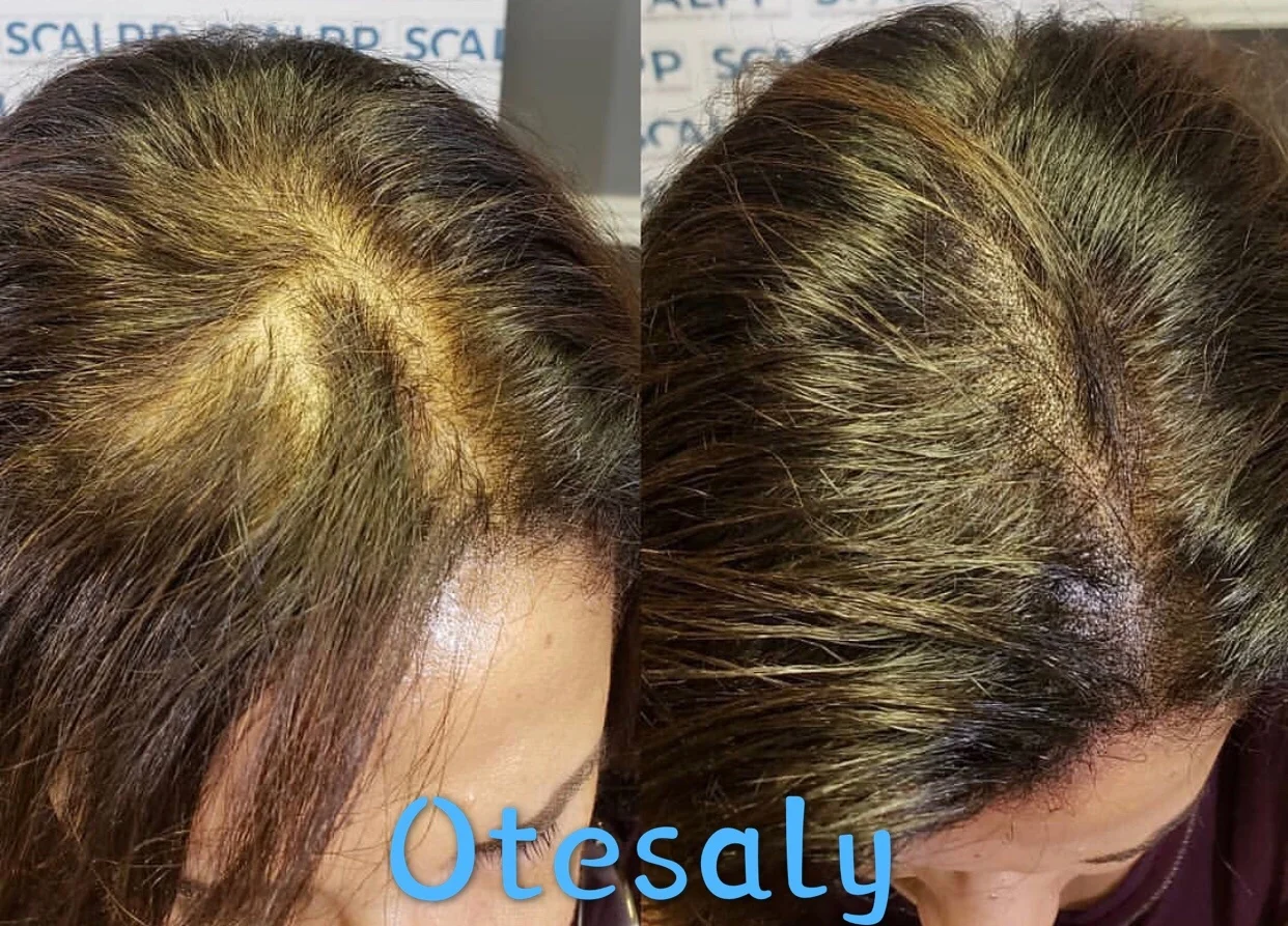 
Factory Direct Otesaly Scalp Injections Anti-hair Loss Mesotherapy Ampoules for Thinning Hair Mediterranean Hair 