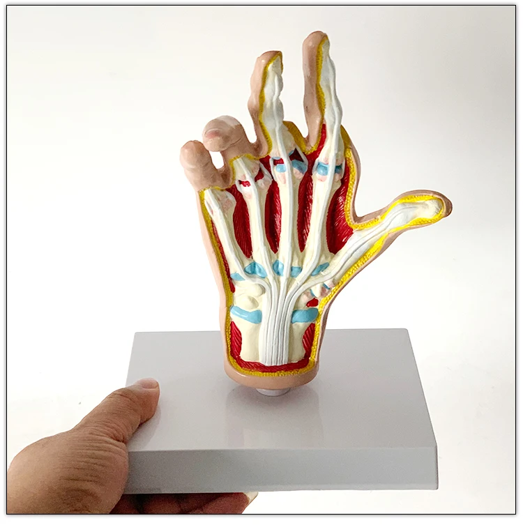 Anatomical model of human hand joint   Arthritis    Rheumatic fever